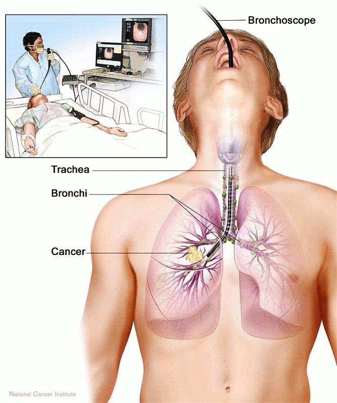 Diagram of a bronchoscopy showing the bronchoscope inserted through the airway into the trachea and bronchi, with an inset of a patient undergoing the procedure.